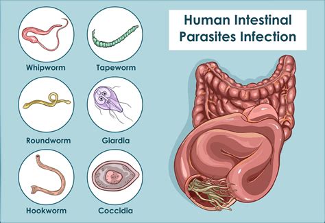 ParasiteInfection